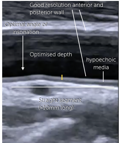 9. Assessment Of Intima Media Thickness (IMT) | 123sonography